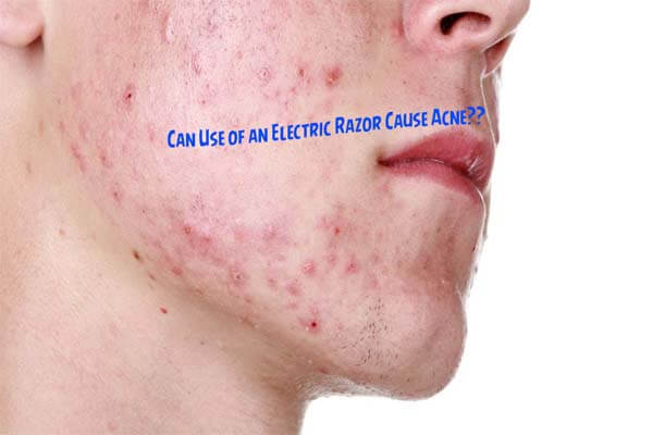 Electric Razor Cause Acne